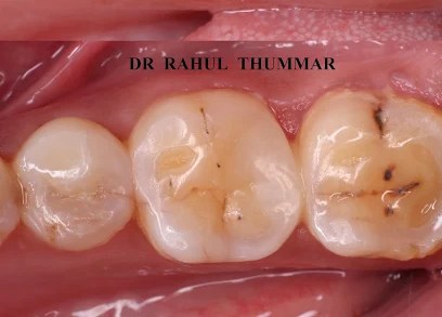 Broken back tooth — after