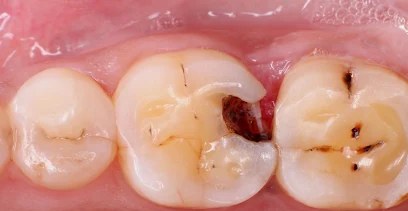 Broken back tooth — before