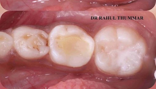 Deep cavity — after