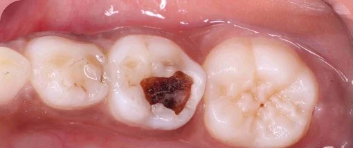 Deep cavity — before