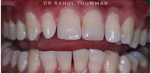 Chipped tooth & gap closure — after
