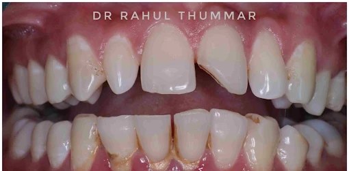 Chipped tooth & gap closure — before