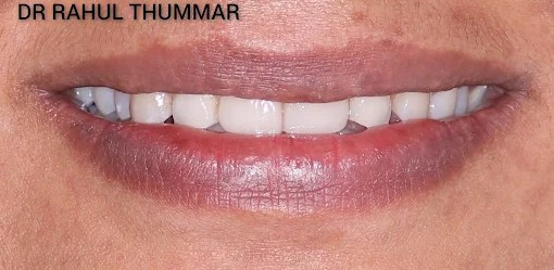 Smile design — after