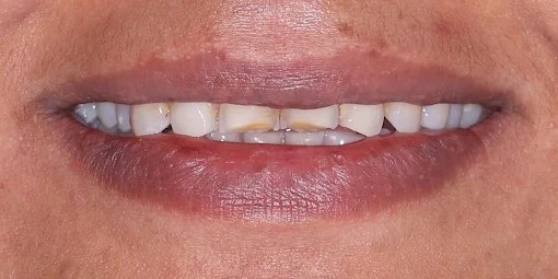 Smile design — before
