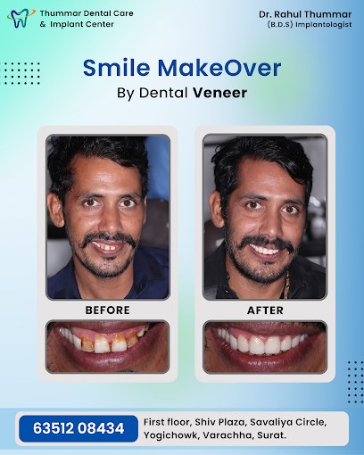 Smile makeover — Dental veneers
